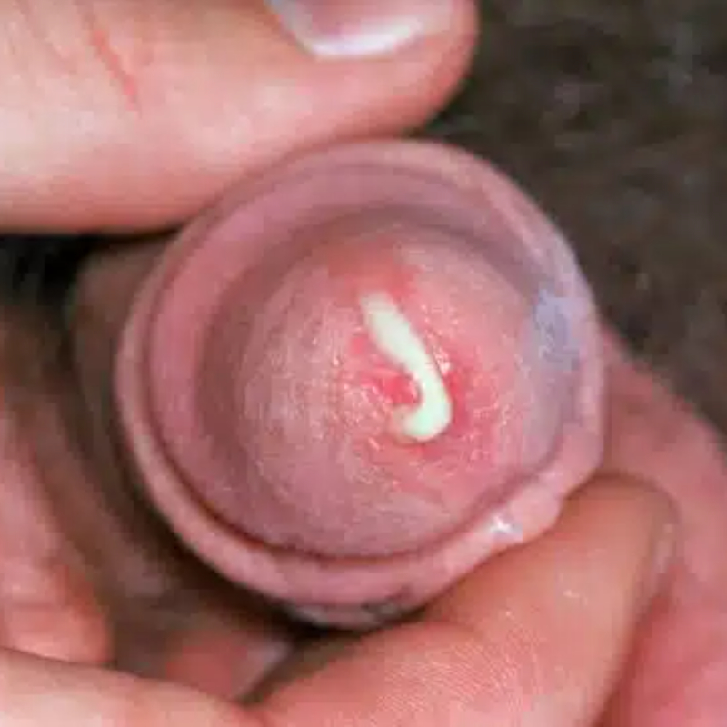 Húgycső kankós fertőzése